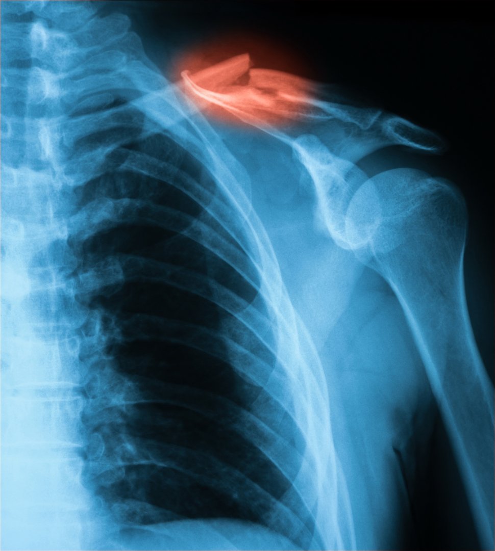 Fracture