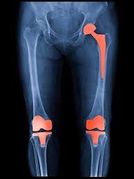 Fracture