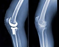 Fracture