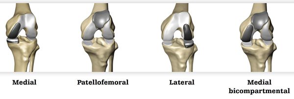 Fracture